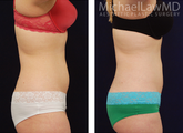 Liposuction