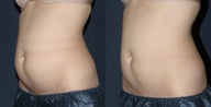 Before & After CoolSculpting