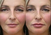 37 year old female lip augmentation with Juvederm.