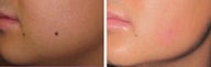 Mole Removal photos