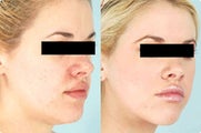 Smart Lipo: Chin Area