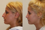 Rhinoplasty Surgery. 6 months post-op.