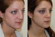 Rhinoplasty Surgery. 6 months post-op.