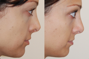 Non-Surgical Nose Job