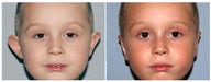 Otoplasty