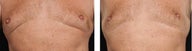 CoolSculpting Effectively Treats Excess Fat in Chest of Men (pseudogynecomastia)