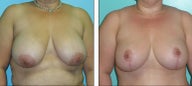 Breast Lift- Mastopexy