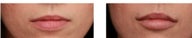 Very thin upper lip is enhanced, and better proportioned, with Juvederm