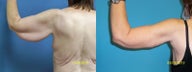 Arm lift with axillary excision