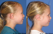 Otoplasty
