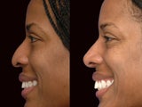 African American rhinoplasty