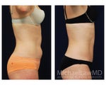 Liposuction
