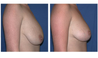 Breast Lift