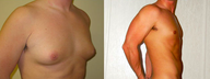Male Breast Reduction
