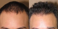 FUE Neograft hair transplantation