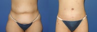 Before and after body lift