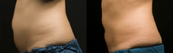 Coolsculpting by Zeltiq