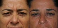 Dysport Glabella