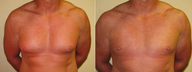 Male Breast Reduction