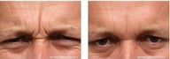 Frown Area treated with Botox and Fillers