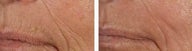 Before and after Combined Laser Resurfacing to Remove Lip Wrinkles