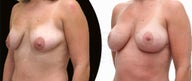 Breast fat grafting with body-jet ( water liposuction)
