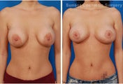 Repair of Botched Breast Lift with Reduction of Areolae