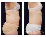 Liposuction