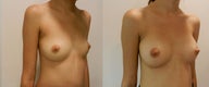 Breast Augmentation