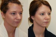 Rhinoplasty Surgery. 1 month post-op
