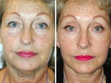 Facelift and Necklift