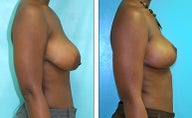 Breast Lift- Mastopexy