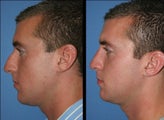 Rhinoplasty