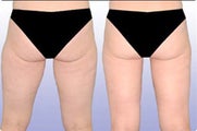 Smart Lipo: Buttocks/Thigh Area