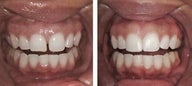 Diastema Dental Bonding