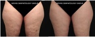 70 Year Old Woman had CoolSculpting for Excess Fat on Outer Thighs