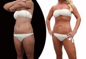 Body-jet liposuction torso and thighs