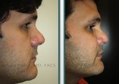 Cheek Implants