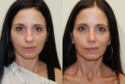 Rhinoplasty Surgery. 1 year post-op.