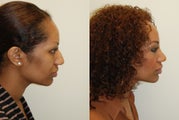 African Rhinoplasty Surgery. 1 month post-op