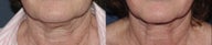Ulthera Neck | Before and After