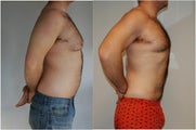 Male Before and After Lipo Chest and Abdomen