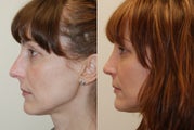 Rhinoplasty Surgery. 1 month post-op