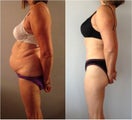 Abdominoplasty / Tummy Tuck Before & After