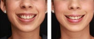 Gummy Smile Treated with Botox