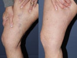 Sclerotherapy
