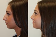 Rhinoplasty Surgery. 2 months post-op.