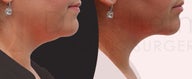 Neck liposuction with body-jet ( water-liposuction)