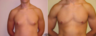 Male Breast Reduction