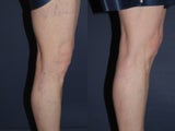 Sclerotherapy For Leg Veins